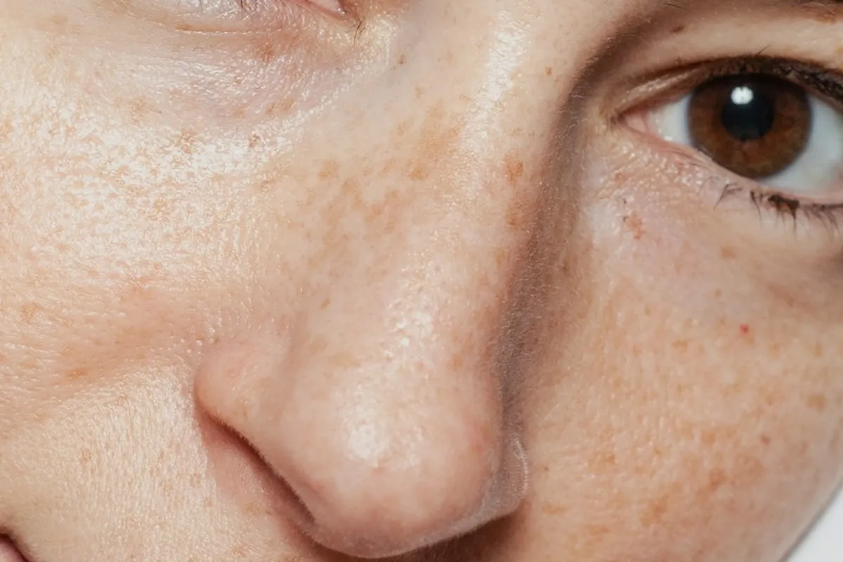 Primer plano de piel del rostro con pecas, fotografía ilustrativa