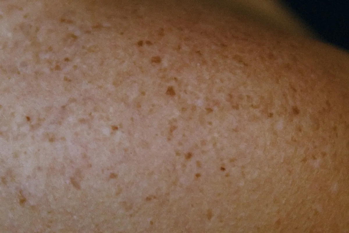 Piel con pecas, fotografía ilustrativa