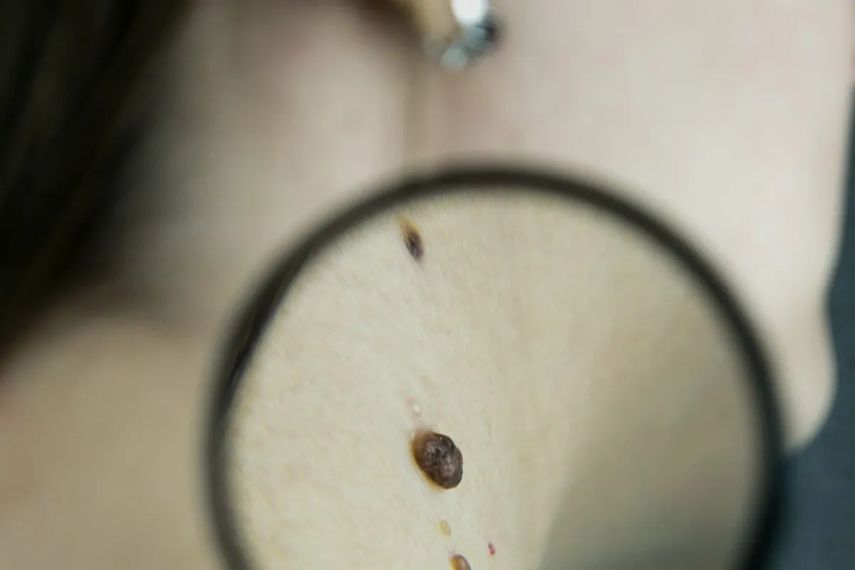 Mole on skin viewed through a magnifying glass, illustrative photograph